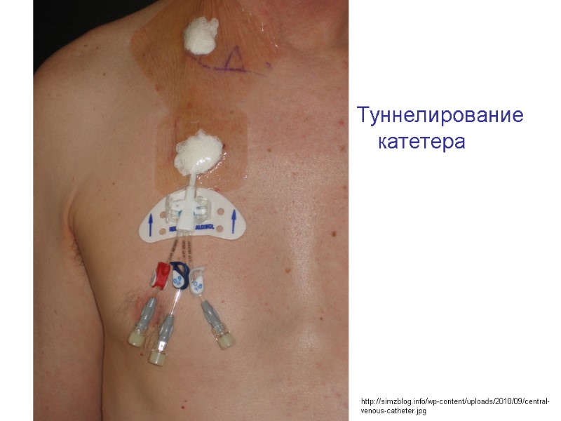 Туннелирование катетера http://simzblog.info/wp-content/uploads/2010/09/central-venous-catheter.jpg